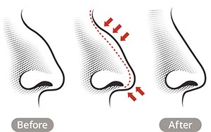 Illustration depicting before and after Rhinoplasty