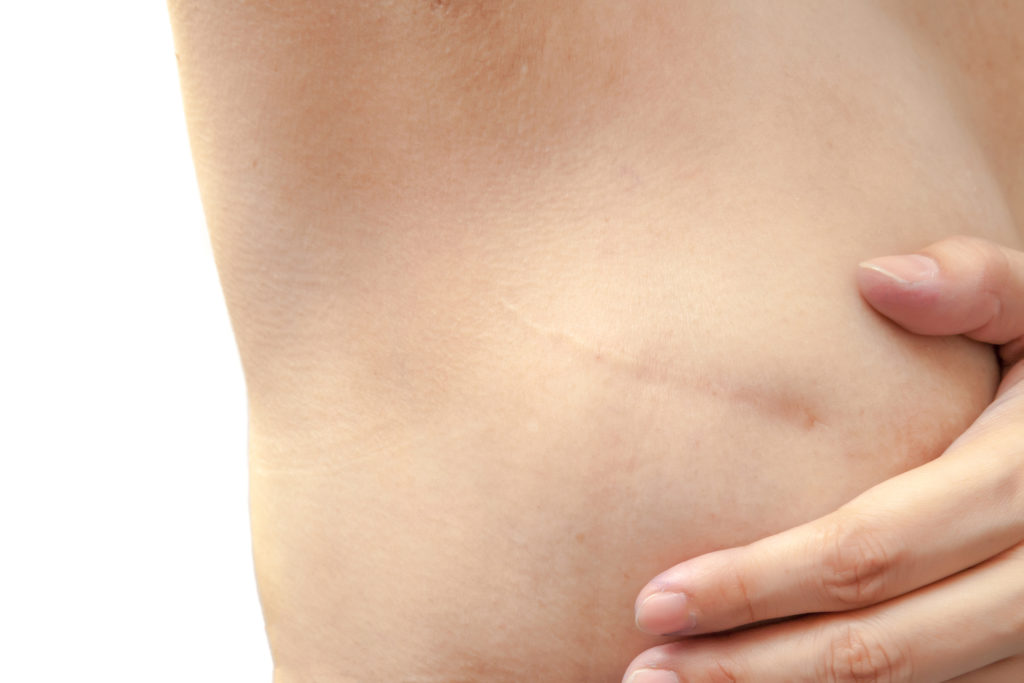 Breast Reconstruction Denver, CO