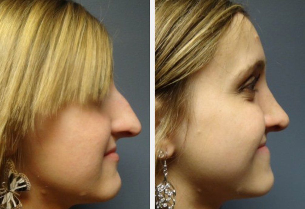 Denver Rhinoplasty Before and After Photos