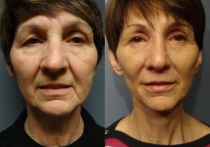 woman before and after a facelift