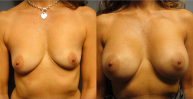breast procedure before and after