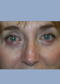 blepharoplasty eyelid surgery bershof plastic surgery 2