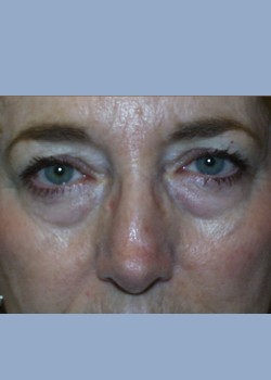 blepharoplasty eyelid surgery bershof plastic surgery 1